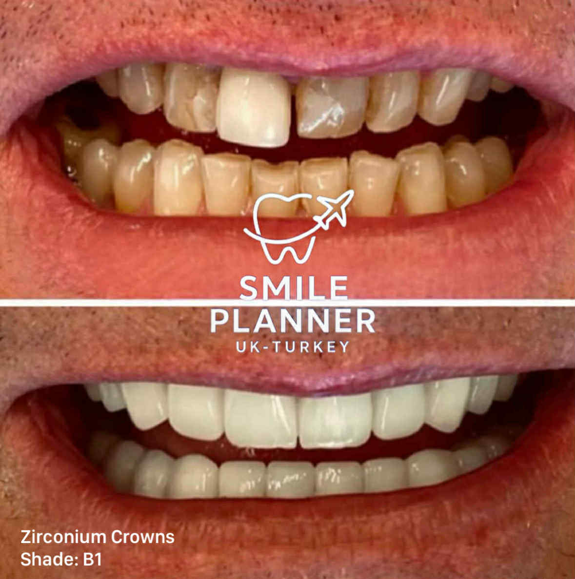 UK Male smile transformation with zirconium crowns in Turkey